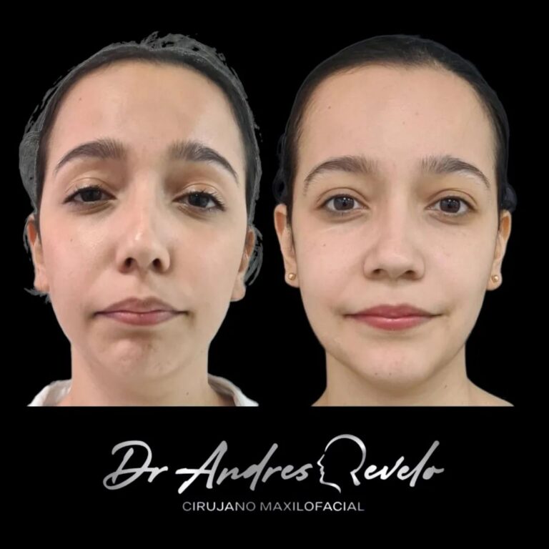 Resultado de cirugía facial