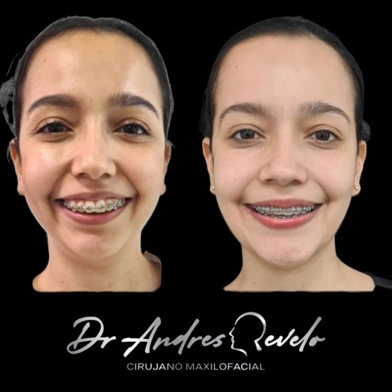 Resultado de cirugía maxilofacial