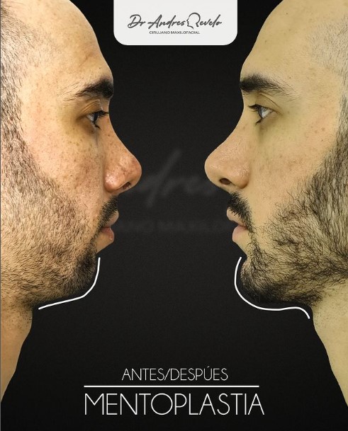 Resultado de mentoplastia