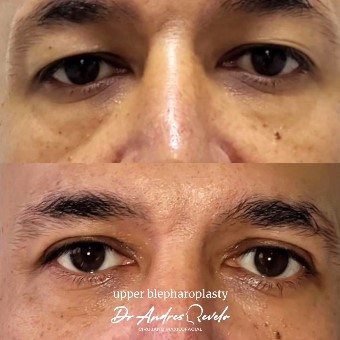 blefaroplastia cali