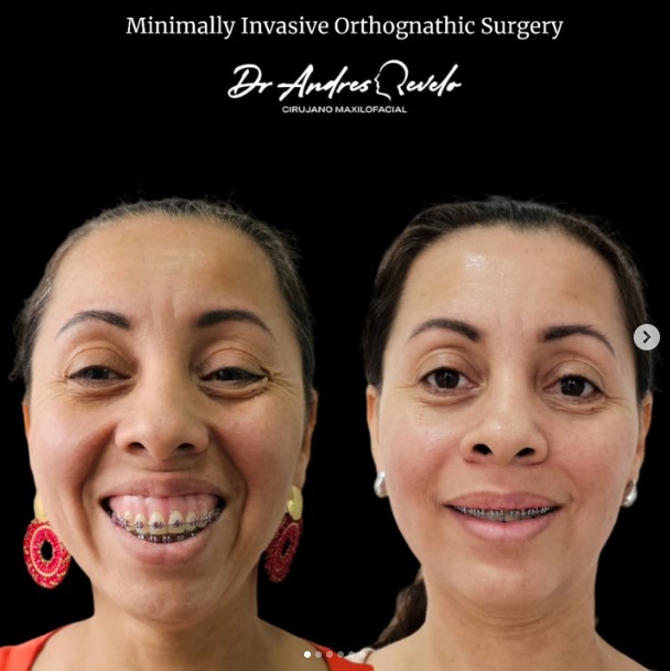 Cirugía Ortognática Caso 1 - Antes y Después